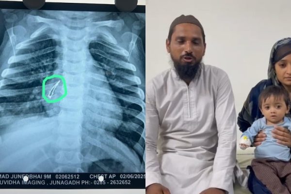 9 महीने के बच्चे ने निगला LED बल्ब, अहमदाबाद में सफल सर्जरी से ऐसी बची जान